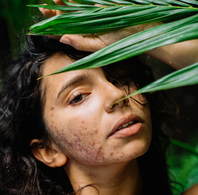 Hormonal Acne and Your Cycle: Causes and Natural Remedies